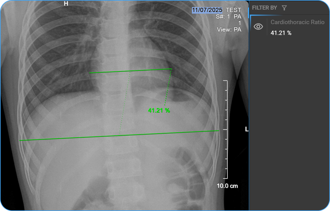 Cardiothoracic Ratio measurement placed on image