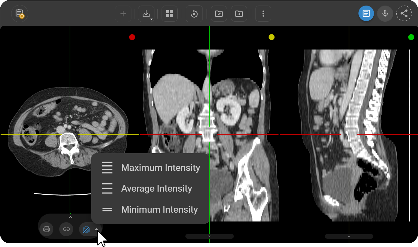 Projection method popup menu showing MIP, AveIP, and MinIP options