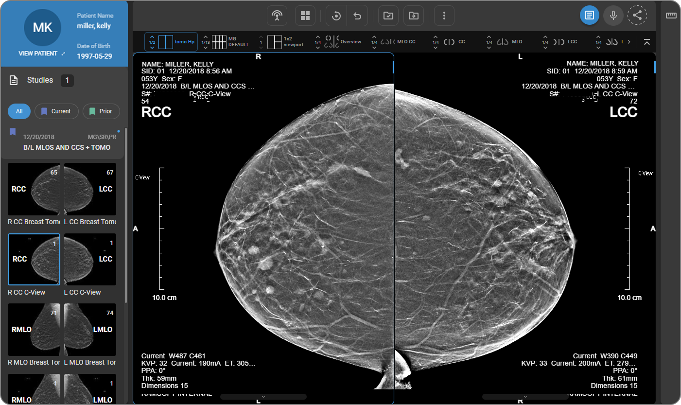 Image placeholder: Side-by-side synchronized left and right mammography images in the viewer