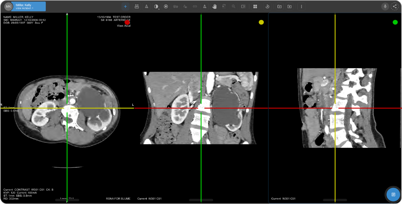 Disposición MPR de tres ventanas de visualización con líneas de referencia en forma de retículo codificadas por colores