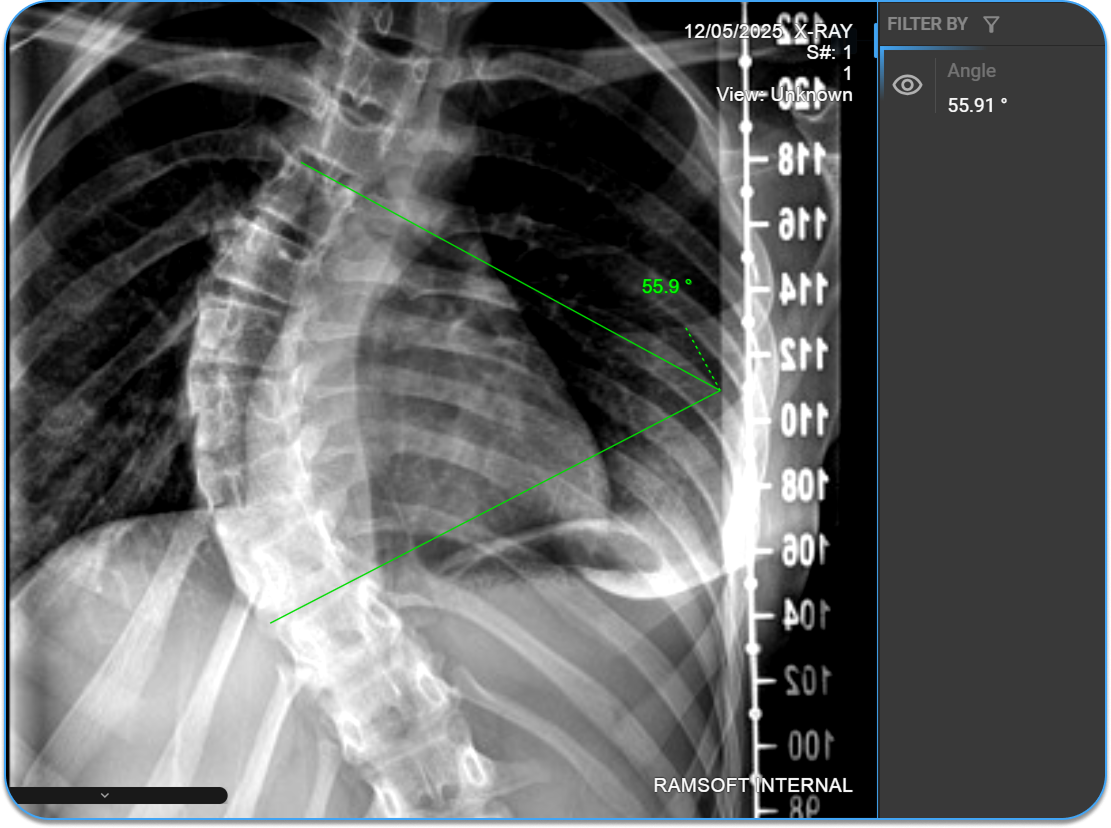 Cobb's Angle placed on image